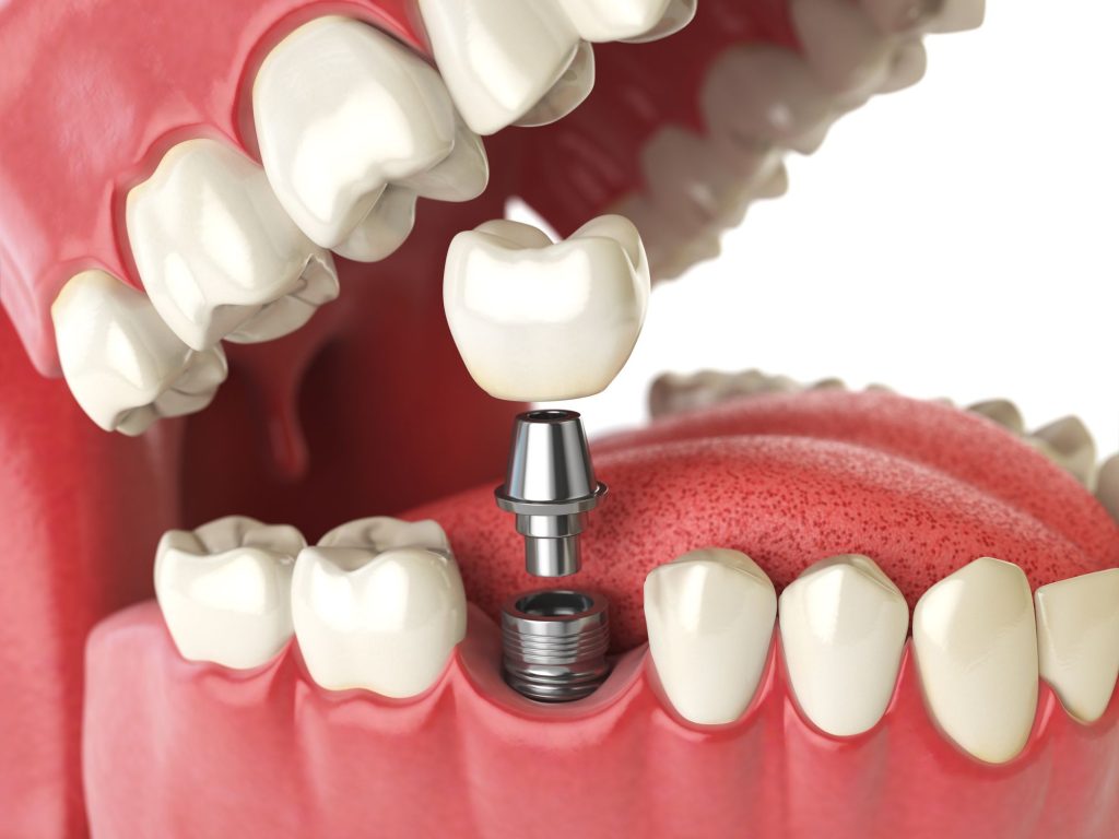 dental-implants.jpg