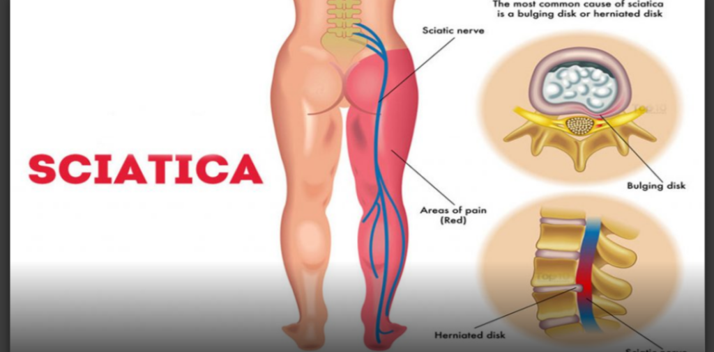 sciatica