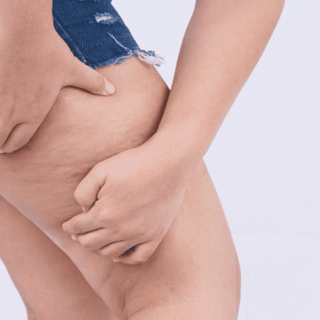Cellulite Treatment in dubai