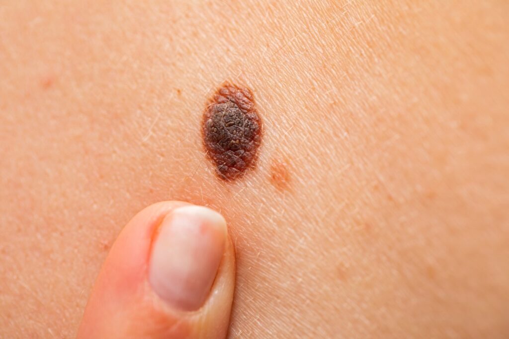 Dermoscopy Mole Evaluation