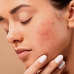 Laser Scar Removal In Dubai.