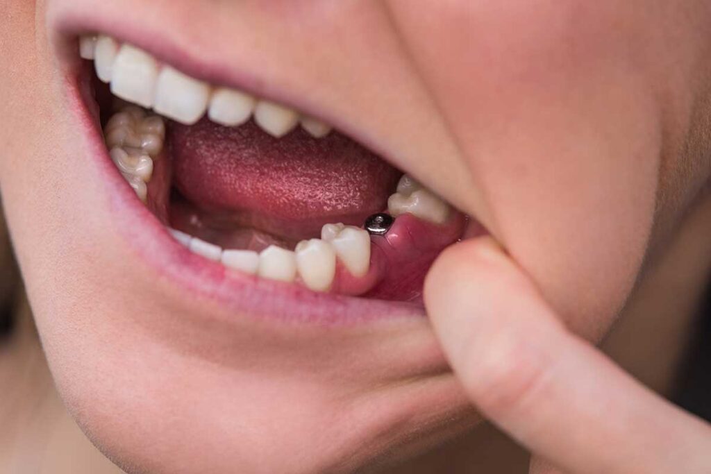 3-What-is-a-Single-Tooth-Implant-