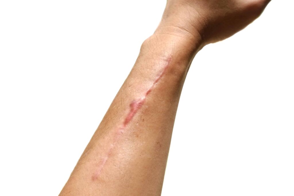 KELOID 129